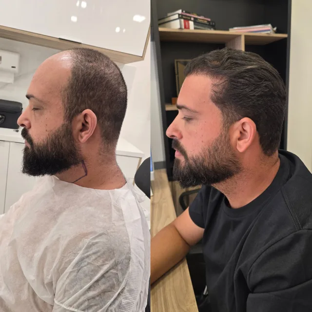 Resultado de transplante capilar: antes e depois