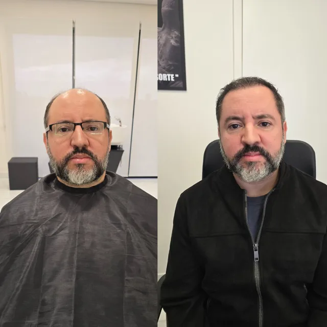 Resultado de transplante capilar: antes e depois