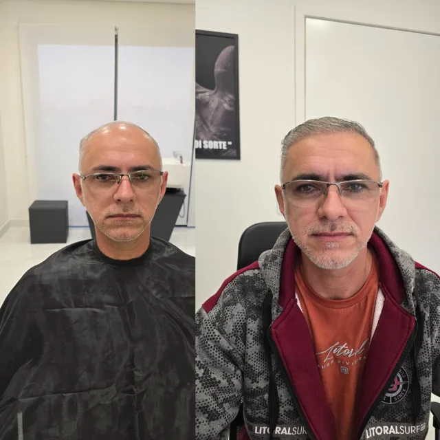 Resultado de transplante capilar: antes e depois