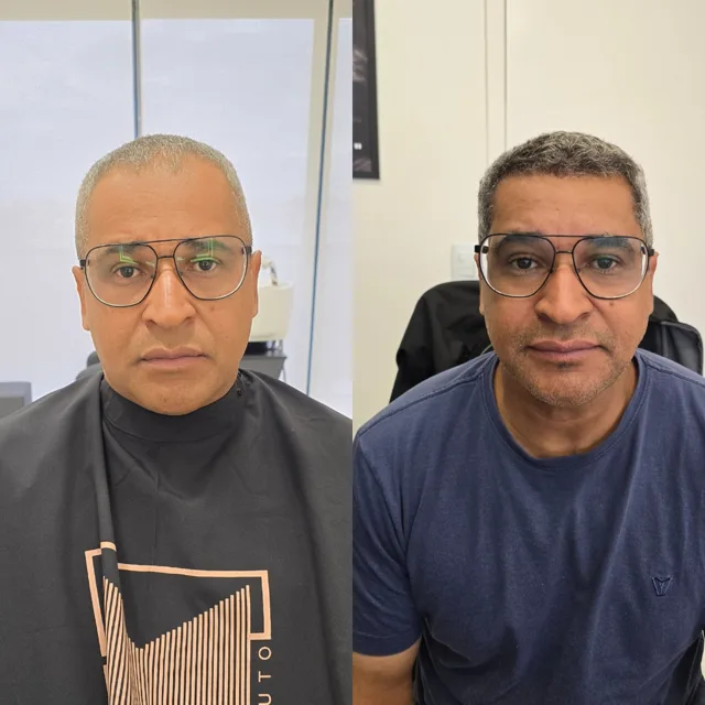 Resultado de transplante capilar: antes e depois