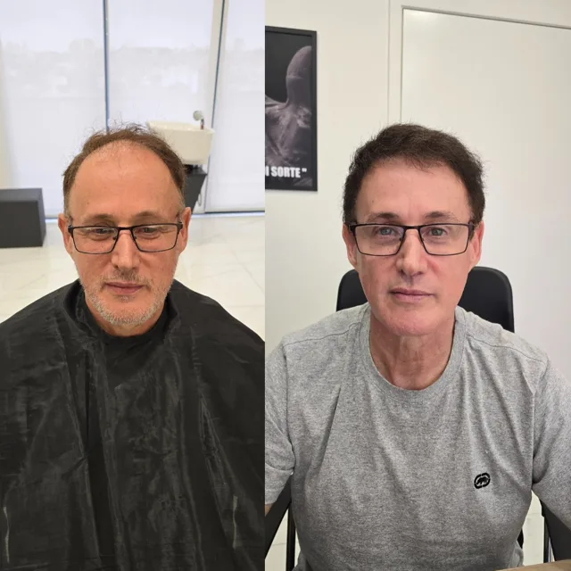 Resultado de transplante capilar: antes e depois