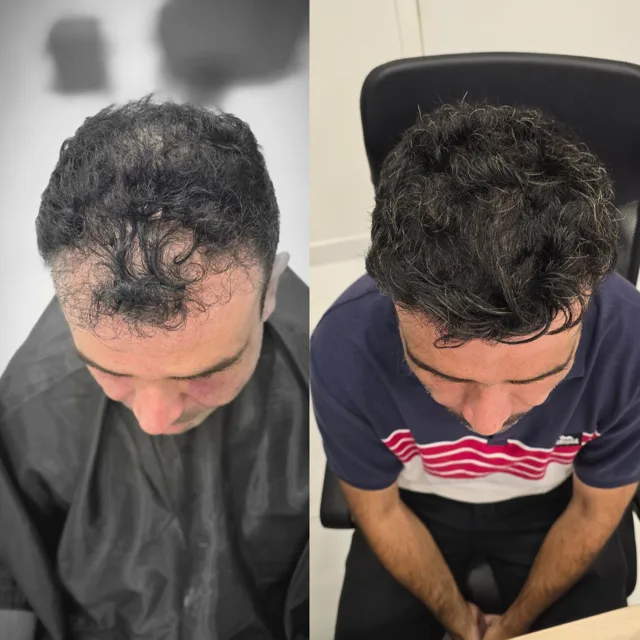 Resultado de transplante capilar: antes e depois